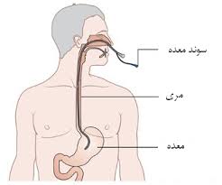 سوند معده در منزل