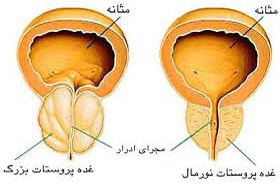 سرطان پرستات