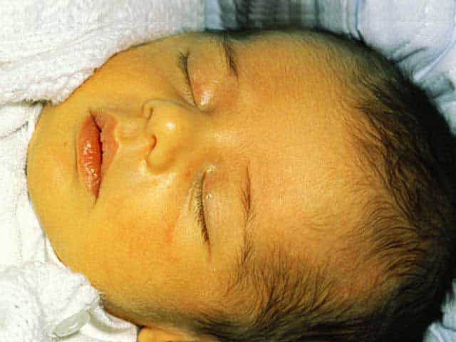 تست زردی نوزاد از طریق پوست