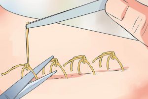 مراقبت هاي لازم پس از بخیه