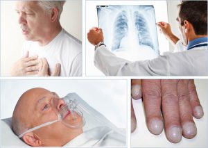 ادم ریوی در سالمندان