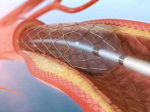 آنژیوگرافی قلب