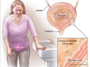 هماچوری چیست