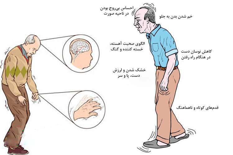 علائم بیماری پارکینسون