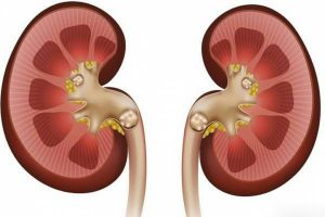 سنگ کلیه