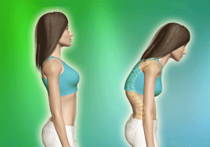 کیفوز یا قوس پشتی