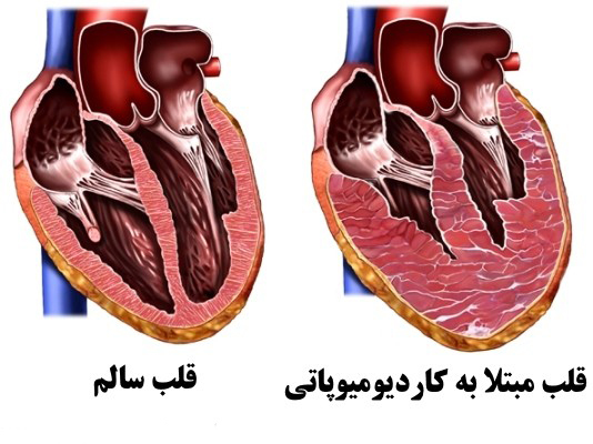 بیماری کاردیومیوپاتی