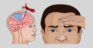 اختلال سرگیجه و علائم آن