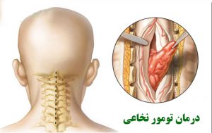 تومور طناب نخاعی