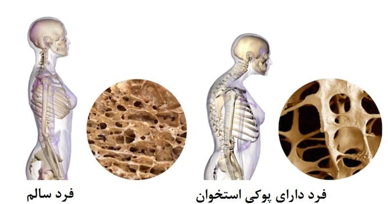 درمان پوکی استخوان