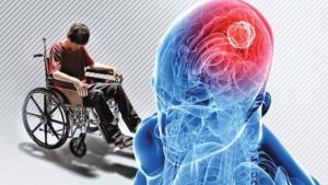 بیماری ام اس