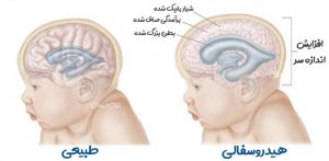 هیدروسفالی
