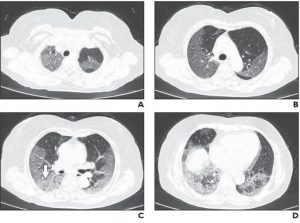 سی تی اسکن ریه بیماران مبتلا به کرونا