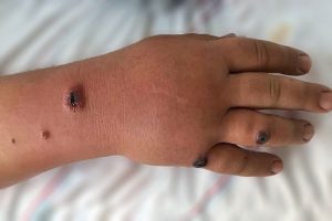 سیاه زخم چیست