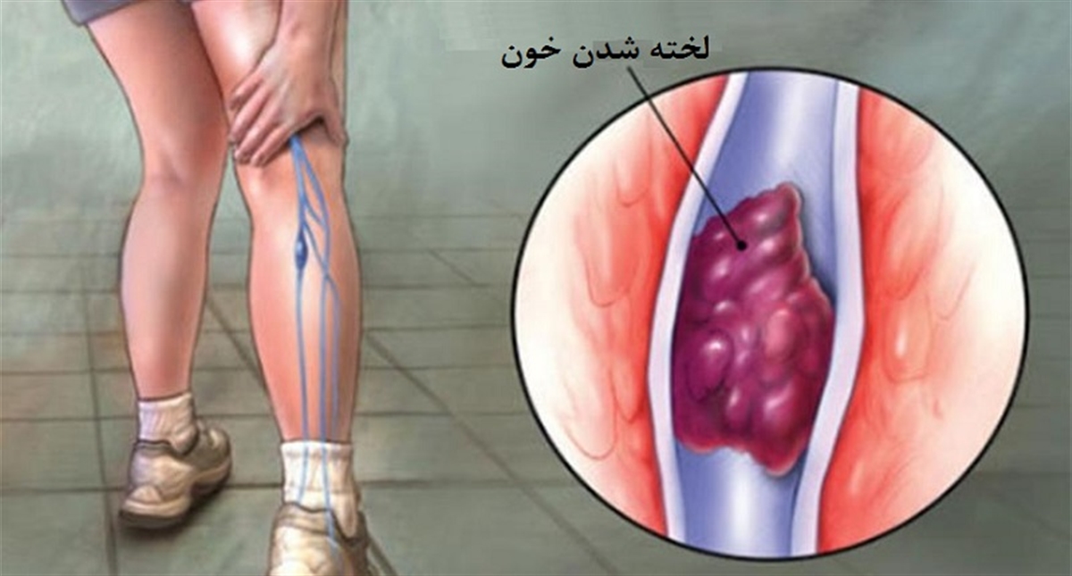 علائم لخته خون در بدن چیست؟