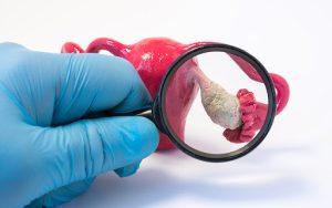 نحوه درمان کیست های تخمدان