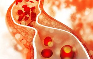 دیس ‌لیپیدمی چیست؟