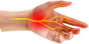 سندروم تونل کارپال چه زمان اتفاق میافتد؟