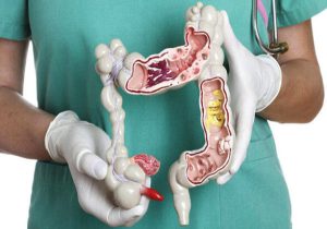 سرطان کولون(روده بزرگ)