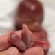 سقط جنین و علائم آن