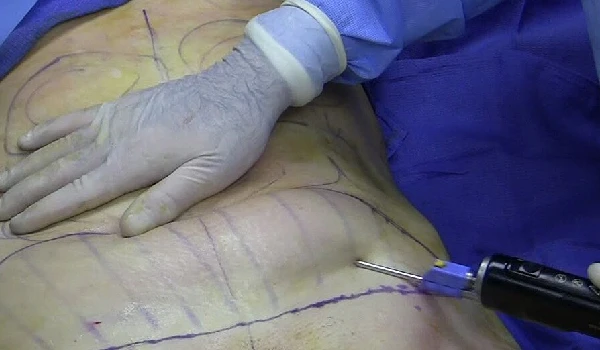 فیلم عمل جراحی لیپوساکشن شکم