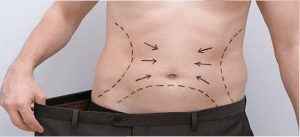 لیپوساکشن چیست؟