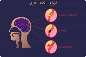 جلوگیری سکته مغزی