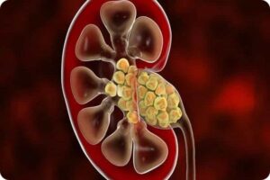 جلوگیری از سنگ کلیه