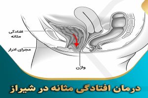 درمان افتادگی مثانه در شیراز