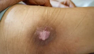 پیشگیری از زخم بستر