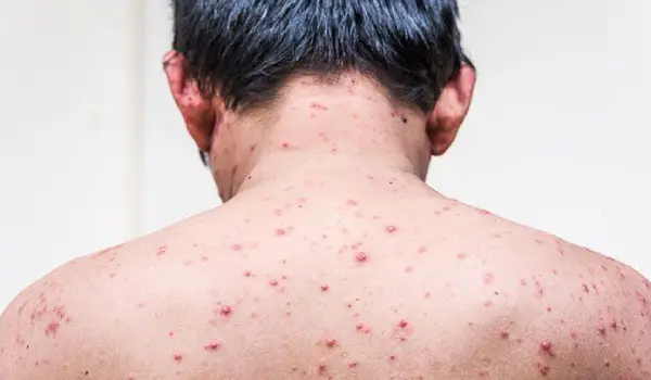  ابله مرغان در بزرگسالی چیست و چرا اهمیت دارد؟
