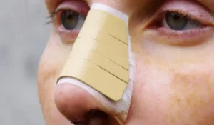 مراقبت های بعد از عمل بینی در روزهای اول