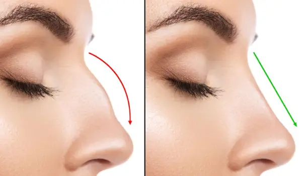 نکات مهم بعد از عمل بینی