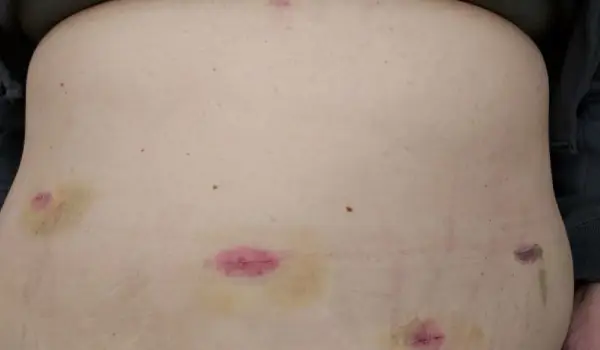 مراقبت از زخم جراحی اسلیو معده