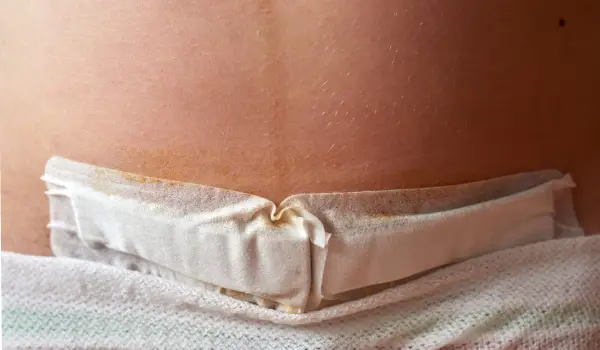 تا چند روز بعد سزارین درد داریم؟