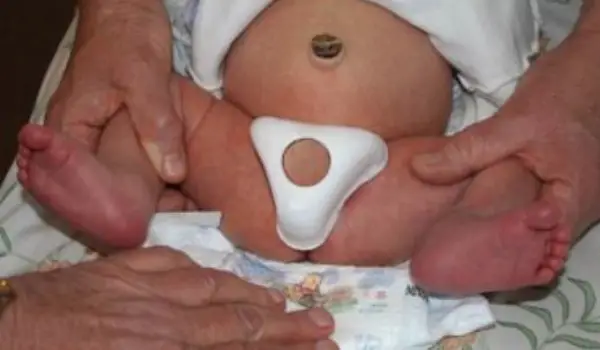 مراقبت های بعد از ختنه با بخیه