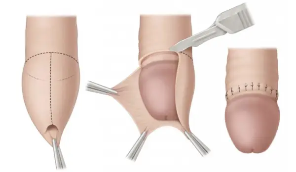 ختنه تا چند روز درد داره و چه زمانی کاملا خوب میشه؟