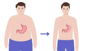 مراقبت های بعد از اسلیو معده