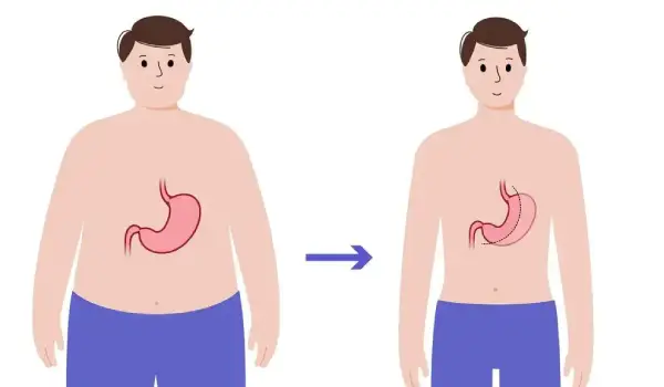مراقبت های بعد از اسلیو معده