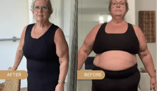 بعد از عمل اسلیو در ماه چند کیلو وزن کم میشود؟