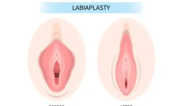 مراقبت های بعد از عمل تطبیق جنسیت زن به مرد