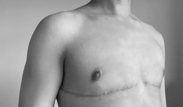 عوارض عمل تغییر جنسیت از مرد به زن