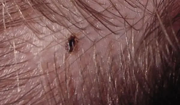 مهم‌ترین علت بازگشت شپش سر پس از درمان