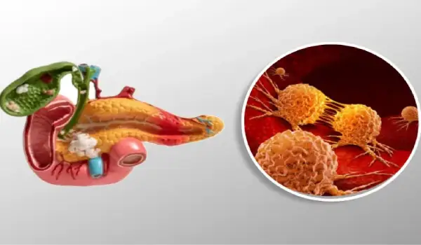 تصاویر سرطان پانکراس