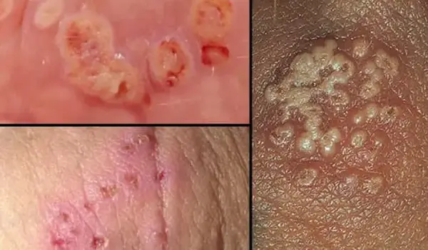 تبخال تناسلی به چه شکلی است؟